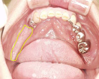 吉本歯科医院での症例 写真2