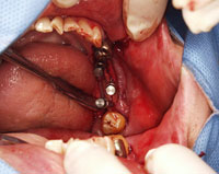 3. いよいよインプラント埋入