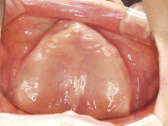 オールオン４治療をされた患者様の口内写真