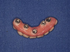 オールオン４に使用する人工歯（上面写真）
