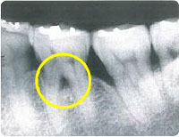 歯科のレントゲン
