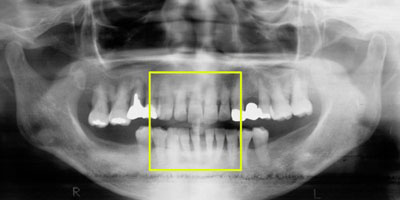 症例1 上下前歯の骨吸収