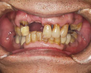 上顎にインプラント治療予定