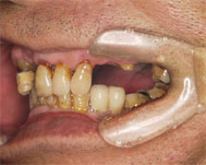 上顎にインプラント治療予定