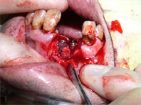 インプラントを埋入