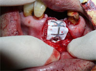 特殊な膜やプレートでおおい、その後縫い合わせます