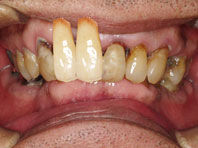 GBR(骨再生療法)行なわずにインプラントを行なった場合